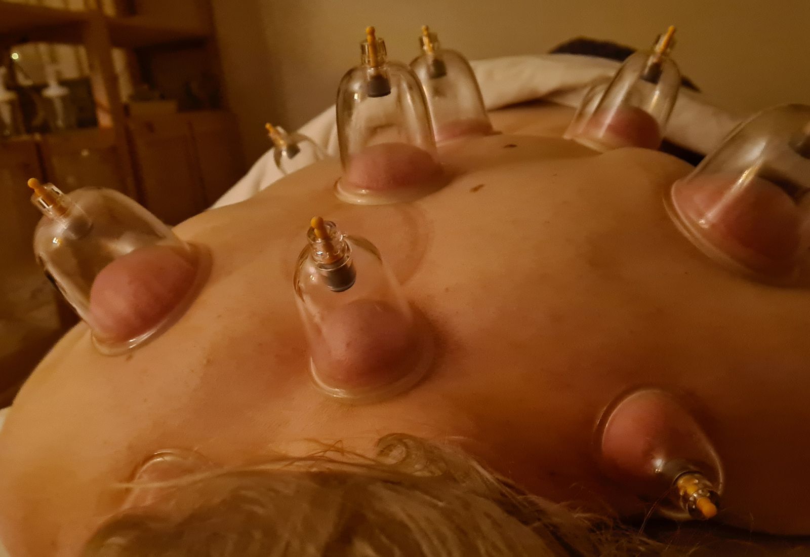 Cupping-kopper på en klients ryg